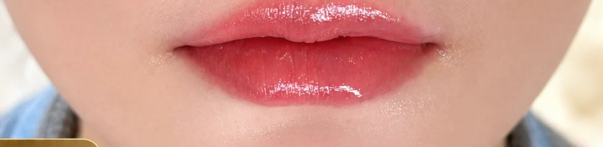 Lip Enhancement after treatment
