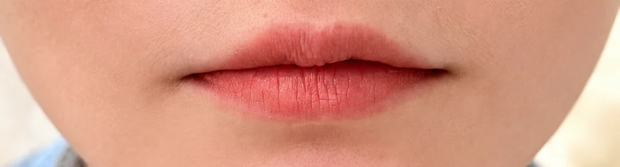 Lip Enhancement before treatment